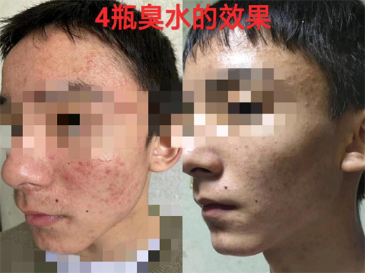 箐源草本臭水成分與功效